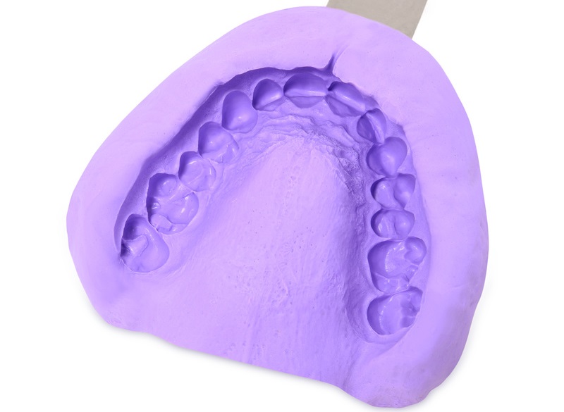 Bọc răng sứ mất bao lâu để hoàn thành? 3