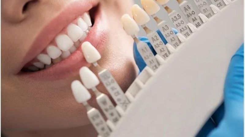 Bọc răng sứ và 8 lợi ích bạn nên biết trước khi thực hiện 1