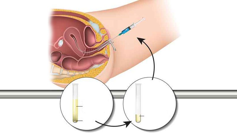bom-tinh-trung-bao-lau-thi-biet-co-thai 1.jpg
