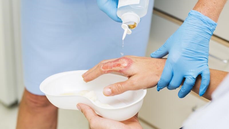 Bỏng độ 2: Phân loại, cách chăm sóc và phục hồi sau thương tổn 2