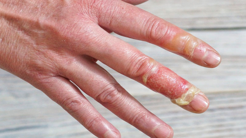 Bỏng độ 2: Phân loại, cách chăm sóc và phục hồi sau thương tổn 4