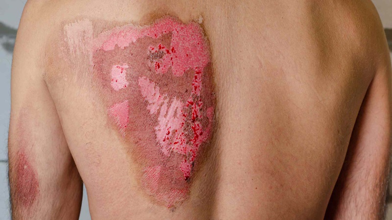 Bỏng độ 3 bao lâu thì khỏi? Cách xử trí và phòng ngừa 1