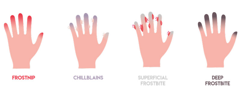 Bỏng lạnh có chữa được không? 1