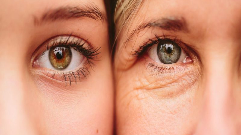 Bọng mắt và quầng thâm: Nguyên nhân và cách xử lý 2