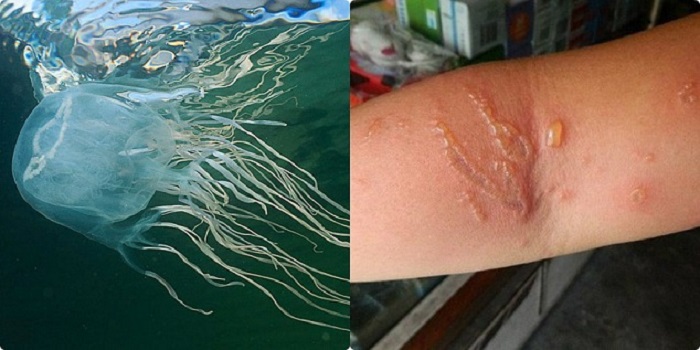 Bỏng sứa là gì? Phải làm gì khi bị bỏng sứa? 1