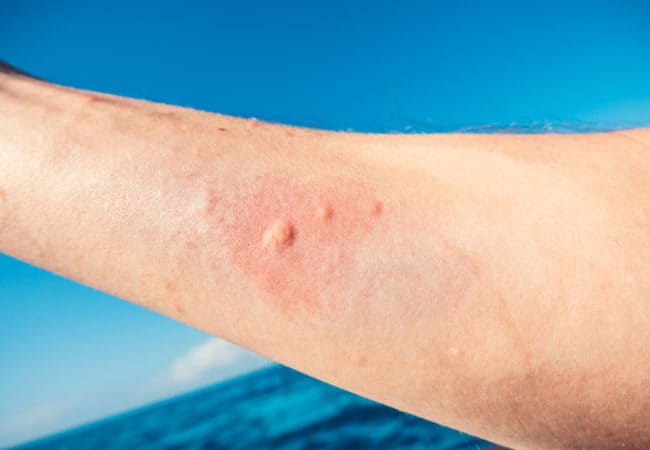 Bỏng sứa là gì? Phải làm gì khi bị bỏng sứa? 2