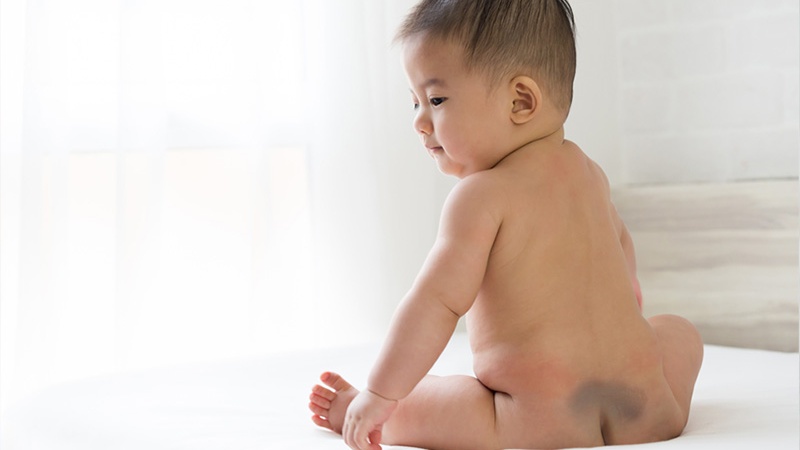 Có nhiều nguyên nhân dẫn đến hình thành vết bớt xanh trên da trẻ