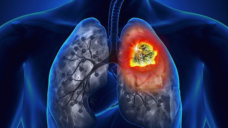 Tìm hiểu về các bệnh ung thư phổ biến và biến chứng 2