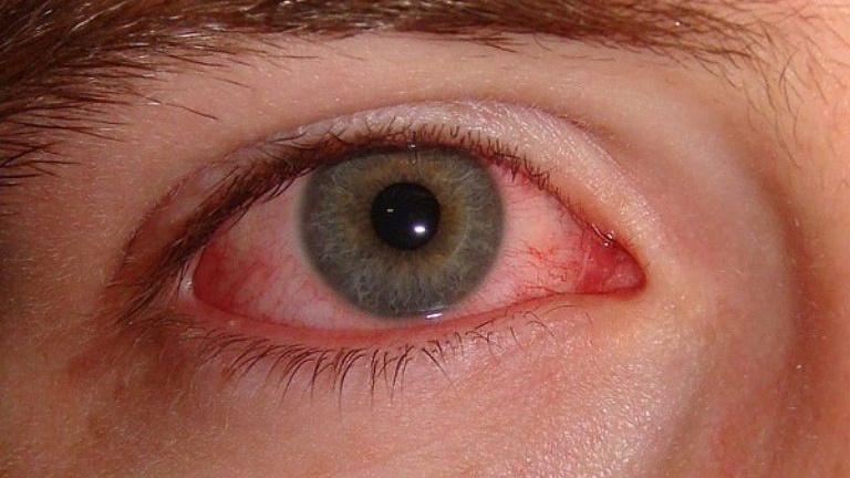 Các biện pháp hỗ trợ điều trị mắt sưng đỏ có ghèn 1