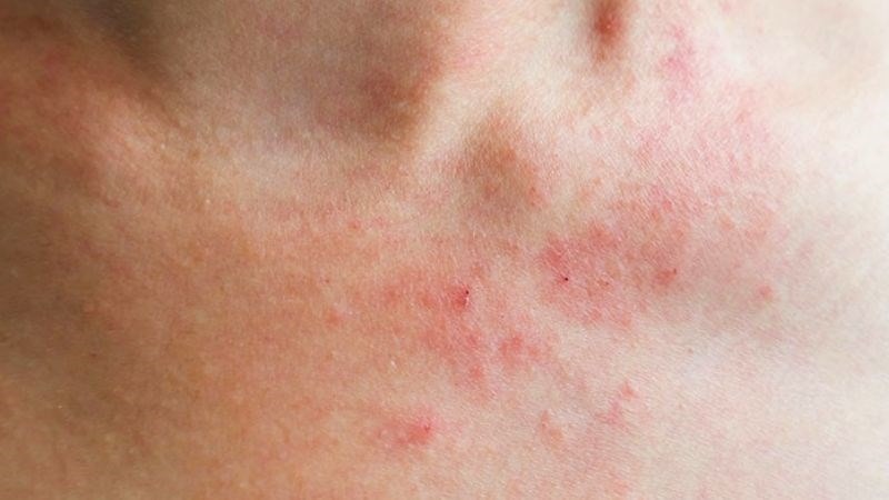 Các dấu hiệu thiếu vitamin B6 và cách khắc phục chúng? 2