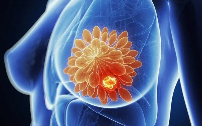 cac-dau-hieu-u-vu-va-cac-yeu-to-nguy-co 1.jpg