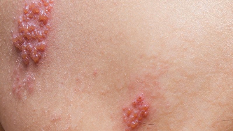 Các giai đoạn của zona thần kinh và cách điều trị hiệu quả 9