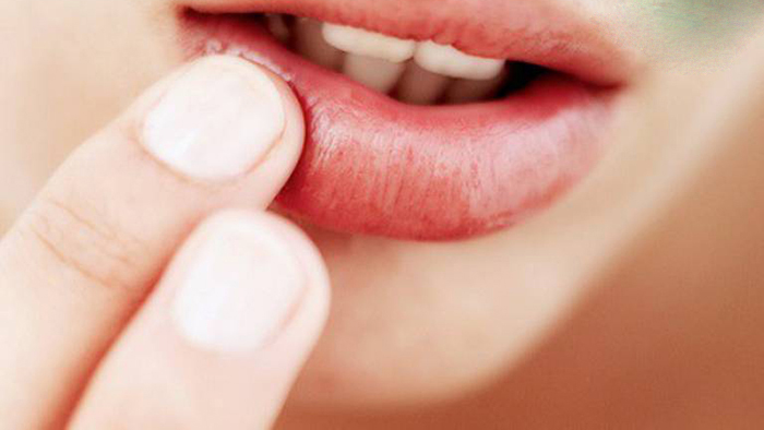 Sùi mào gà ở lưỡi giai đoạn đầu​ có nguy hiểm không? Những biến chứng nếu không điều trị kịp thời  2