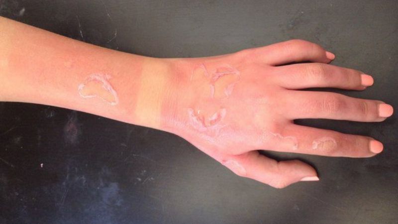 Cách khắc phục vết bỏng với kem đặc trị Hyalo4 Plus 1