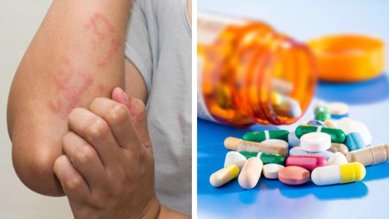 Các loại dị ứng​ thường gặp và cách phòng ngừa hiệu quả 6