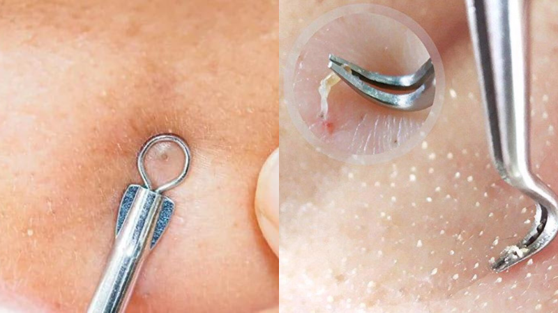 Các loại dụng cụ nặn mụn và cách dùng chuẩn xác nhất 6