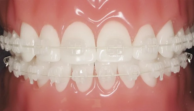 Các loại mắc cài sứ phổ biến hiện nay: Ưu, nhược điểm từng loại 1