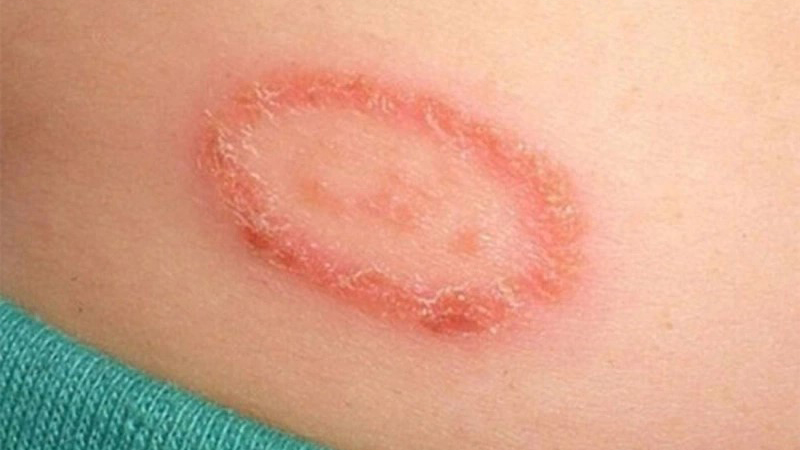 Các loại nấm da​ phổ biến và cách điều trị, ngăn ngừa hiệu quả 3