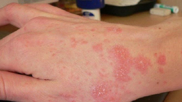 Các loại nấm da​ phổ biến và cách điều trị, ngăn ngừa hiệu quả 2