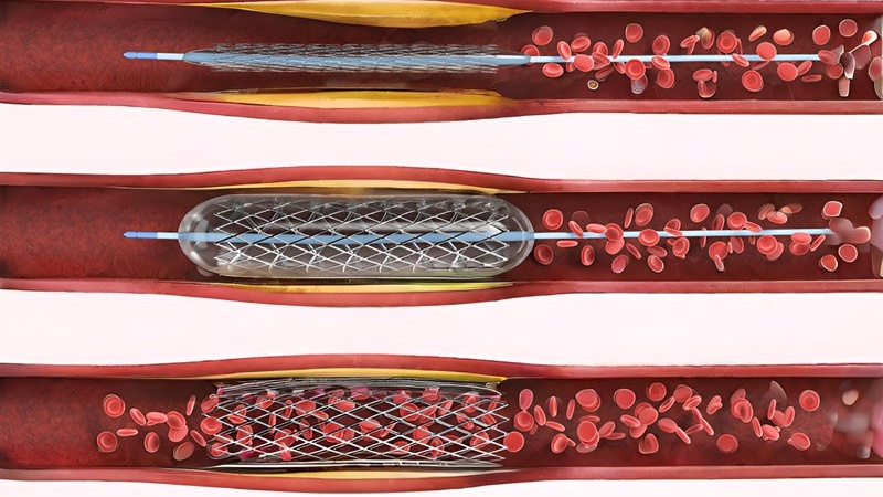 cac-loai-stent-mach-vanh-duoc-su-dung-hien-nay-gom-nhung-loai-nao 1