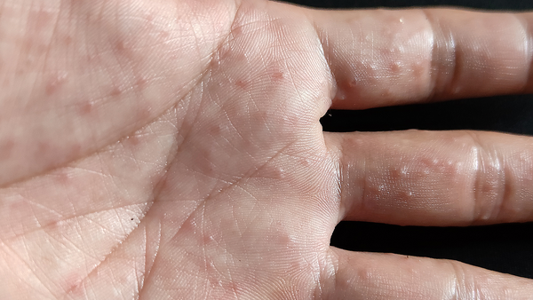 Các loại thuốc trị nước ăn tay hiệu quả và an toàn 1