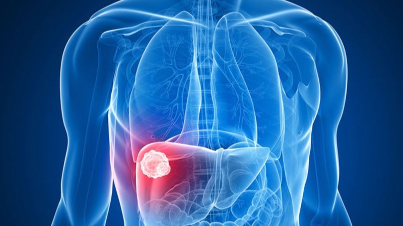 Các loại ung thư gan thường gặp và cách phòng ngừa 1