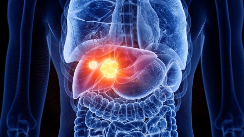 Các loại ung thư gan thường gặp và cách phòng ngừa 2