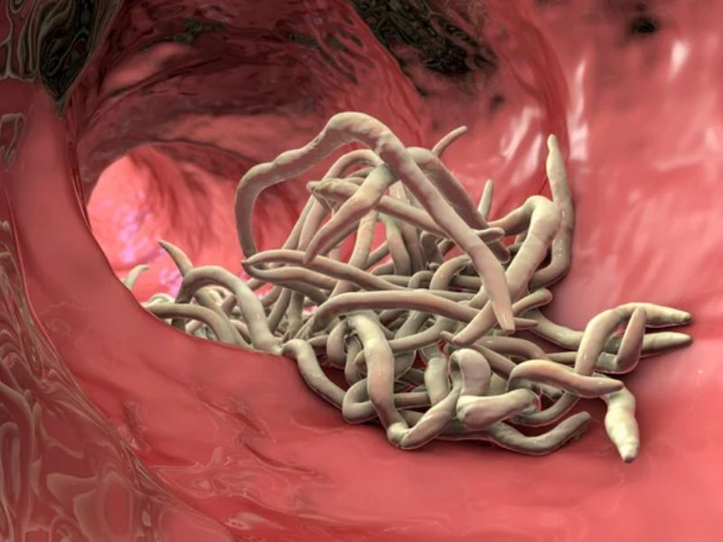 Các nguyên nhân viêm ruột thừa phổ biến bạn cần nắm 3