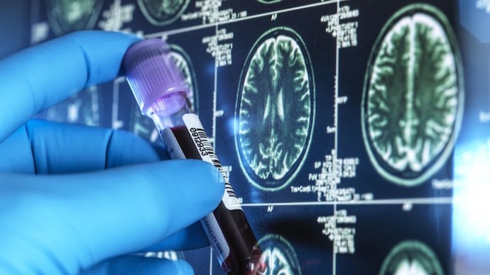 Các nhà khoa học phát hiện ra dấu hiệu dịch não tủy để phát hiện và điều trị bệnh Alzheimer 2