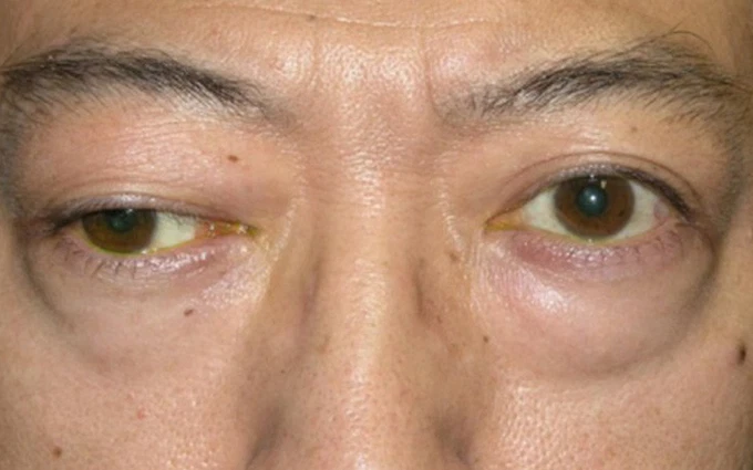 Các nhóm xét nghiệm cường giáp phổ biến hiện nay1