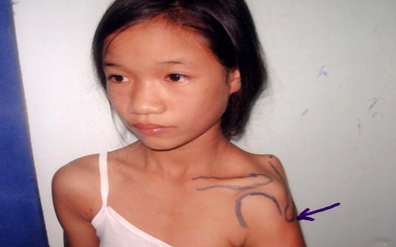 Các phương pháp chữa trị bệnh xơ hóa cơ delta? 2