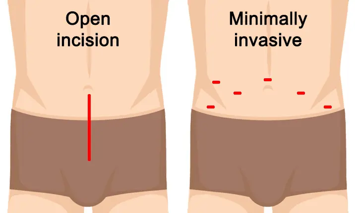 Các phương pháp điều trị trong phẫu thuật ung thư tuyến tiền liệt 2