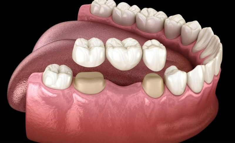 cac-phuong-phap-trong-rang-gia-pho-bien-hien-nay 3.jpg