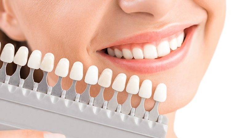 Các tông màu của răng sứ thông dụng hiện nay 1