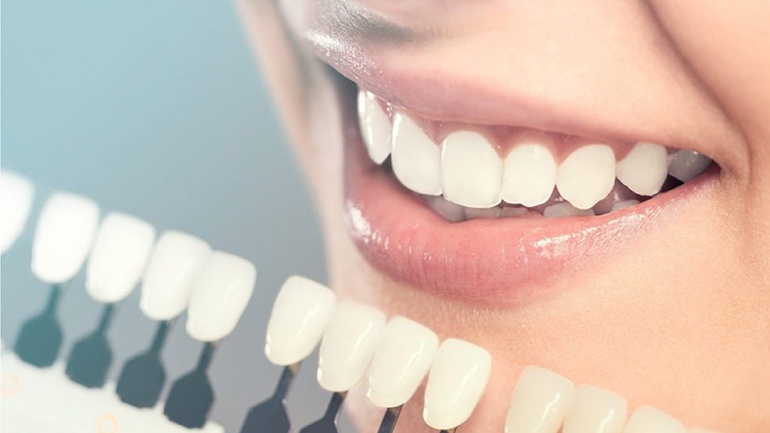 Các tông màu của răng sứ thông dụng hiện nay 3