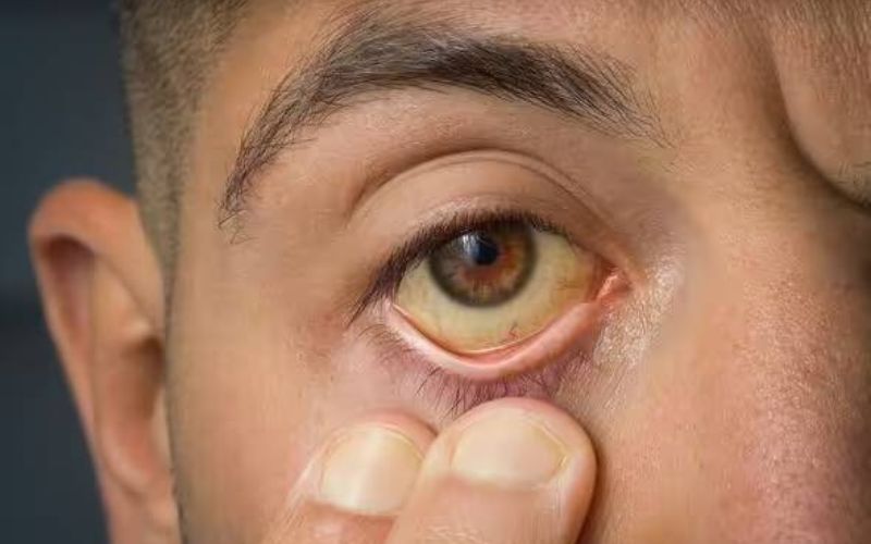 Vàng da là triệu chứng khá rõ ở bệnh nhân viêm gan B