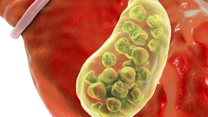 Các xét nghiệm gan ứ mật bạn cần biết 1