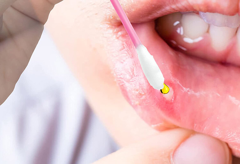 Cách chọn thuốc mỡ bôi nhiệt miệng hiệu quả nhanh chóng 2