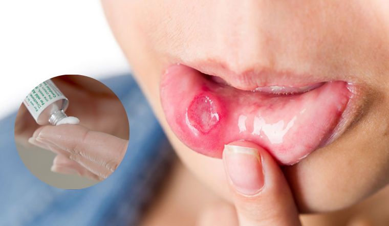 Cách chọn thuốc mỡ bôi nhiệt miệng hiệu quả nhanh chóng 4