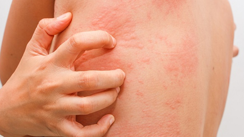 Cách chữa dị ứng khi ăn côn trùng tại nhà 4