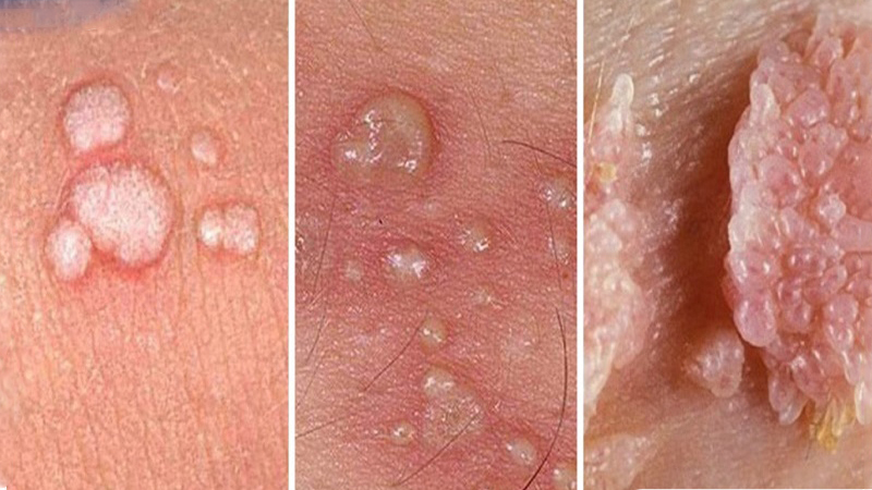 Cách chữa sùi mào gà ở nữ 1