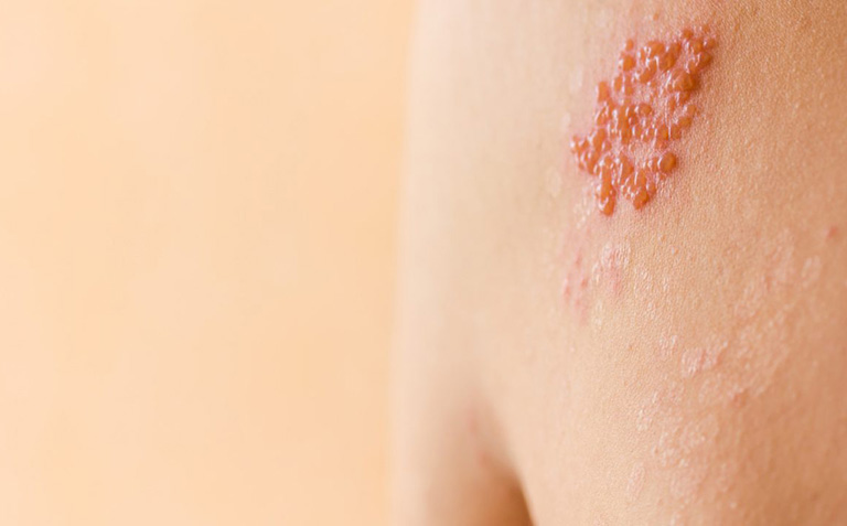 Cách chữa zona thần kinh bằng cây lô hội và những điều cần lưu ý 1