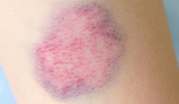 cách giảm sưng khi bị va đập hiệu quả và nhanh chóng 2