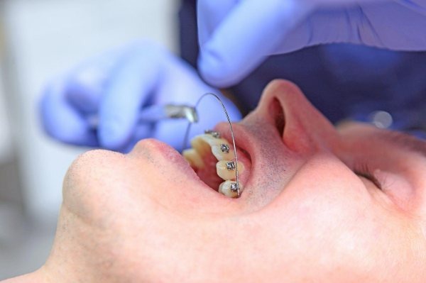 Cách khắc phục dây cung niềng răng đâm vào má 1