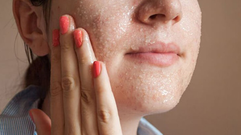 Cách giảm da dầu hiệu quả giúp chị em sở hữu làn da mịn màng, sạch mụn 3