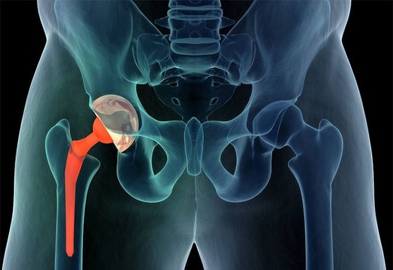 Cách làm giảm đau cơ háng nhanh chóng tại nhà ai cũng nên biết 1