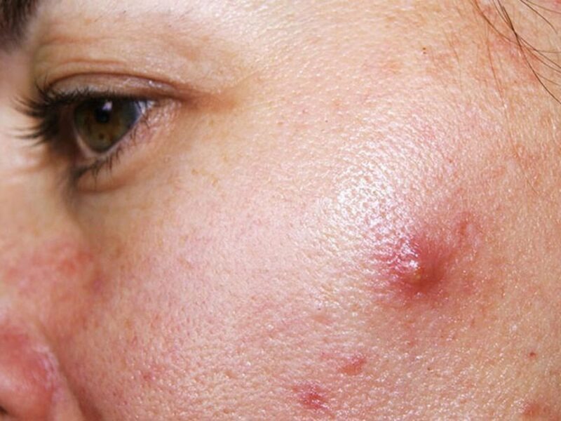 Cách làm xẹp mụn sưng đỏ sau 1 đêm bạn đã biết chưa? 1