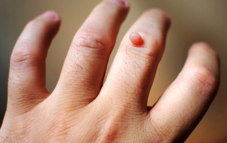 Cách loại bỏ mụn cóc dễ dàng, an toàn bạn nên biết1