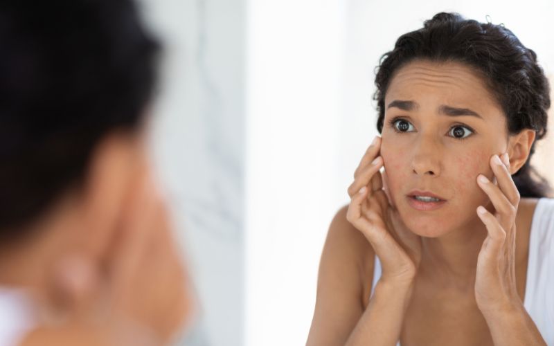 Cách nhận biết da bị kích ứng mỹ phẩm 3