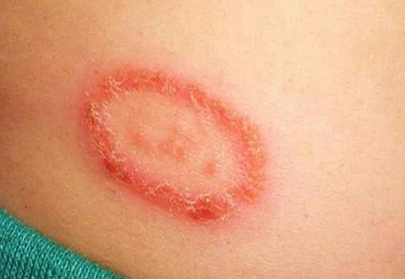 Cách phân biệt các loại bệnh chàm khác nhau 3